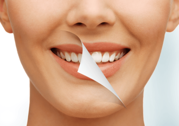 Northampton Dental Group, PC - Teeth Whitening